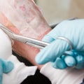 Enzymatic Debridement: Discover How It Transforms Wound Healing