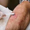Phases of Wound Healing You Should Know to Prevent Infection
