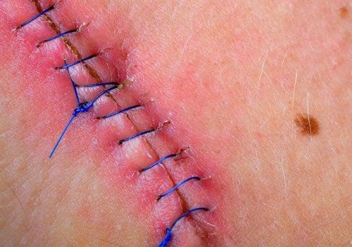 Do Stitches Hurt When Healing or Is It Something More Serious?