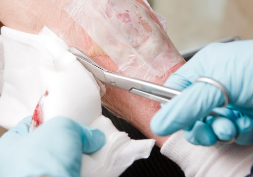 Enzymatic Debridement: Discover How It Transforms Wound Healing